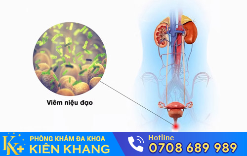 Viêm niệu đạo