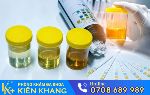 Xét nghiệm nước tiểu giúp phát hiện nhiều bệnh