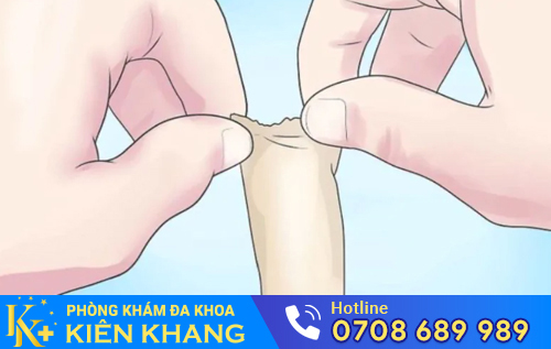 Xử lý rách bao quy đầu sớm phòng tránh nhiều biến chứng nguy hiểm