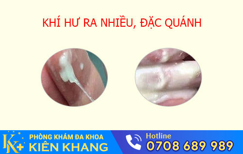 Dấu hiệu nấm âm đạo
