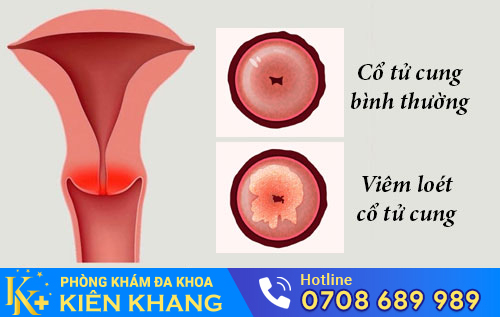 Viêm loét cổ tử cung