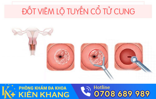 Đốt viêm lộ tuyến cổ tử cung