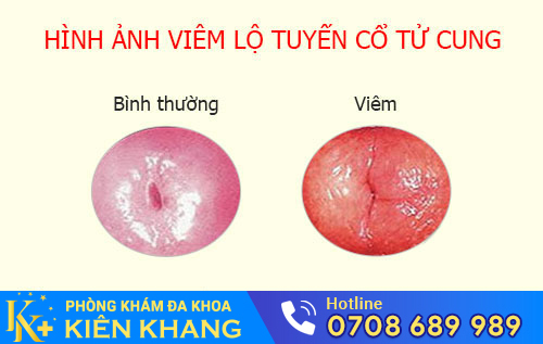 viêm lộ tuyến cổ tử cung