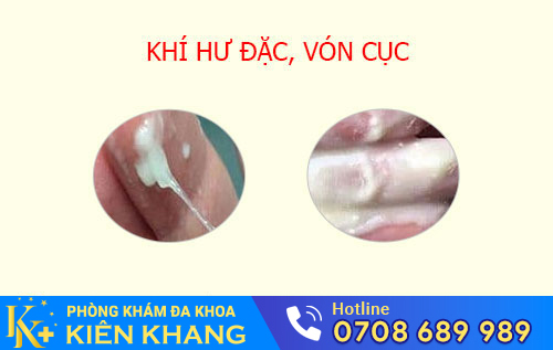 Khí hư đặc, vón cục