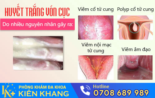 Nguyên nhân huyết trắng vón cục