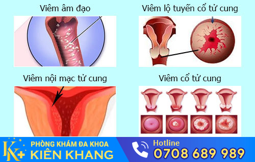 Nguyên nhân khí hư đặc, vón cục
