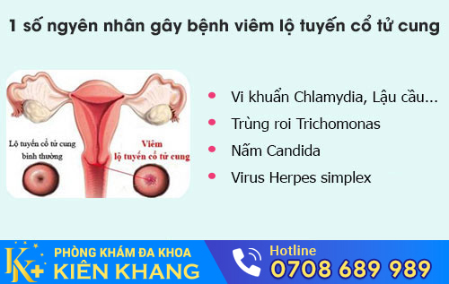 Nguyên nhân viêm lộ tuyến