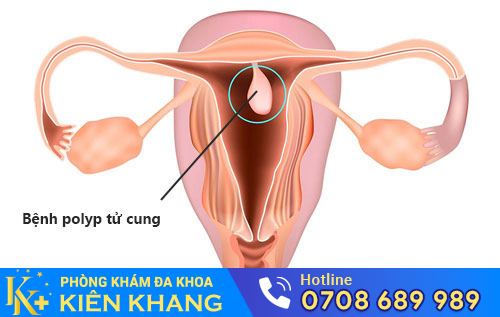 Polyp tử cung