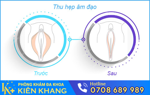 Thu hẹp âm đạo
