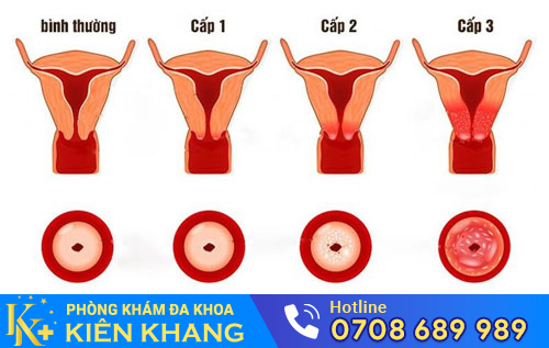 Viêm cổ tử cung