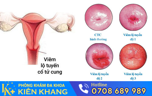 Viêm lộ tuyến cổ tử cung