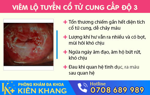 Viêm lộ tuyến cổ tử cung cấp 3