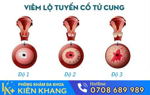 Viêm lộ tuyến cổ tử cung