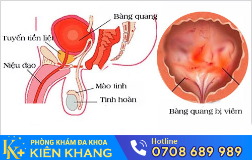 Bệnh viêm bàng quang cấp