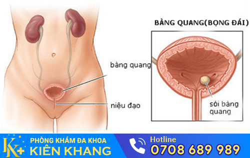 Biểu hiện bệnh sỏi bàng quang