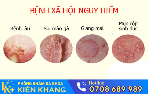 Bệnh xã gây đau bụng dưới