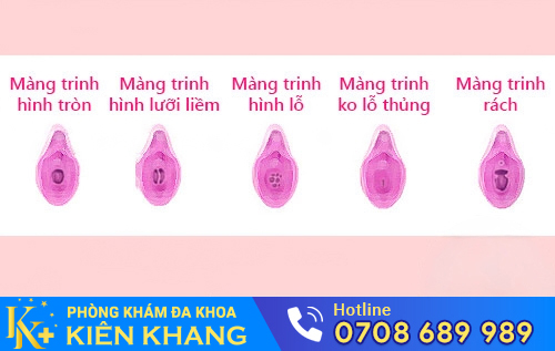 Các dạng màng trinh