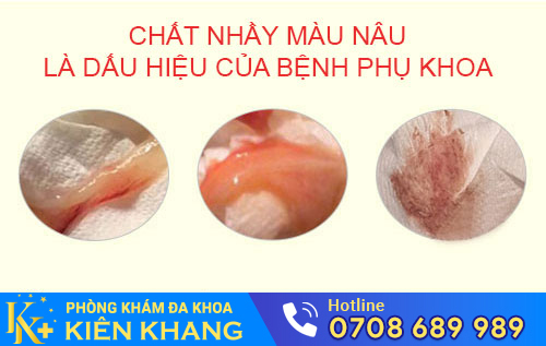 Chấy nhầy màu nâu là dấu hiệu của bệnh phụ khoa