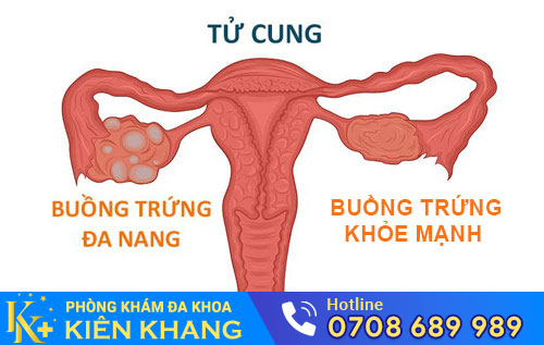 đa năng buồng trứng