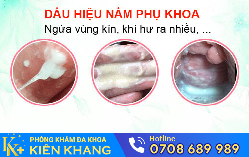 Dấu hiệu nấm phụ khoa