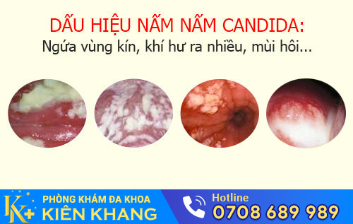 Dấu hiệu nhiễm nấm candida