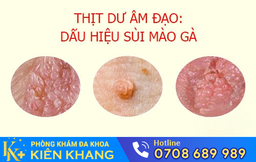 dấu hiệu sùi mào gà