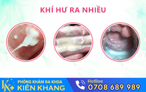 dấu hiệu viêm vùng kín