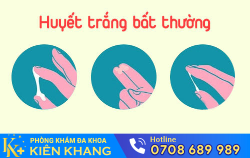 Huyết trắng bất thường