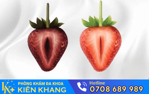 Kết quả sau khi thu hẹp âm đạo