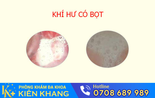 Khí hư có bọt