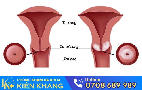 Các bệnh tử cung, cổ tử cung khiến kinh nguyệt có mùi hôi tanh