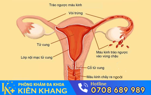 Kinh nguyệt không đều kéo dài có thể là do bệnh phụ khoa gây nên