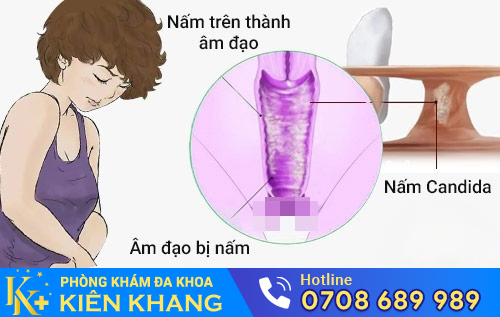 Sưng vùng kín do nấm âm đạo