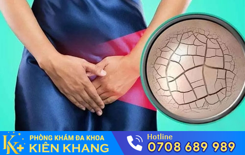 Chứng khô âm đạo