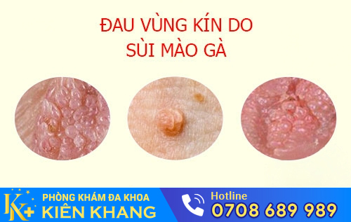 Hình ảnh đau vùng kín ở nữ do mắc sùi mào gà