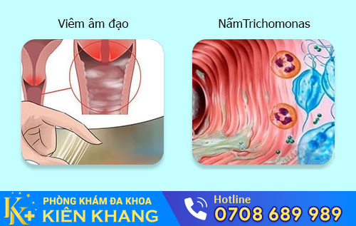 Nguyên nhân khí hư có mùi hôi