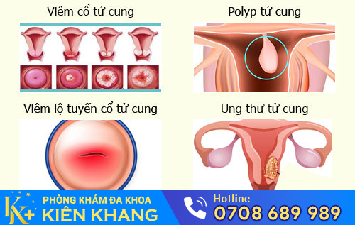 Nguyên nhân kinh nguyệt kéo dài