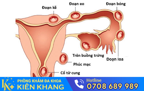 Nguyên nhân máu báo thai bất thường