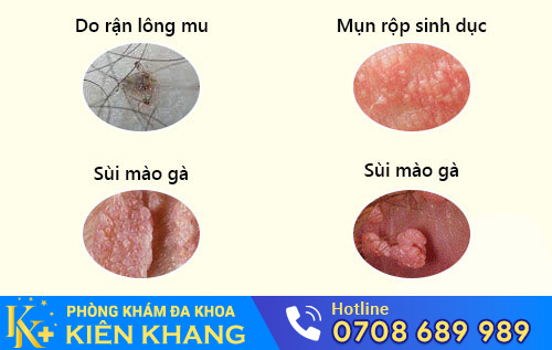Ngứa cô bé do bệnh xã hội