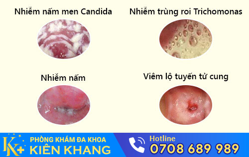 Nguyên nhân ngứa cô bé