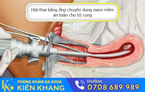 Phá thai bằng ống dẫn siêu mềm an toàn cho tử cung