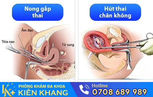 Hút thai chân không, nong gắp thai