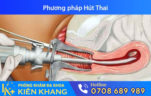Bỏ thai 8 tuần bằng phương pháp hút thai