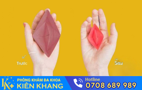 Phương pháp khâu màng trinh