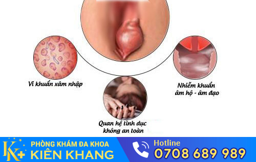 sưng mép âm hộ