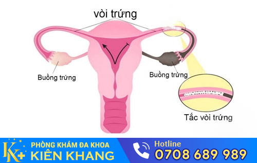 Tắc vòi trứng do viêm nhiễm kéo dài