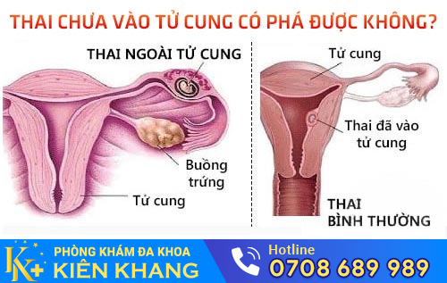 Thai chưa vào tử cung có phá được không