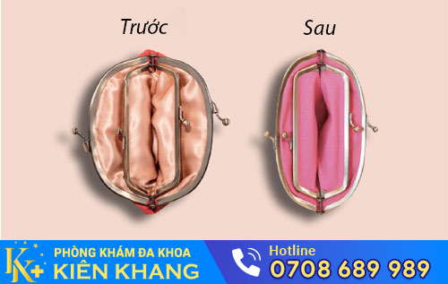 Thu hẹp âm đạo