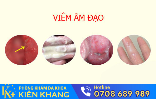 Viêm âm đạo