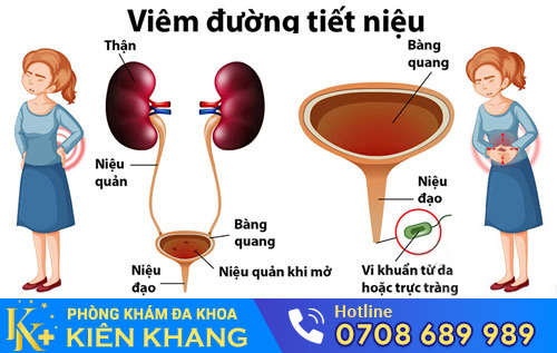 Viêm đường tiết niệu ở nữ giới